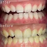 【しっかり白くさせるなら🦷✨】縛りナシ回数制限なし！🉐白さ実感×コスパ最強✨ホワイトニングのみの無制限コース😉✌️