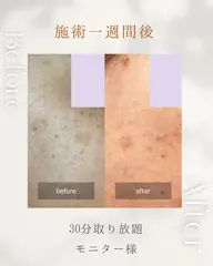 【お悩みのシミをケア】 これ以上作らせない対策も❣️シミケア20分当て放題✨まぶた・ニキビ跡にも可能♪