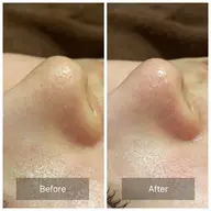 ハイドラフェイシャル お試し 鼻