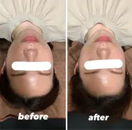 美容鍼+小顔矯正⸝⋆【前回ご来院から1ヶ月以内の方】30%OFF