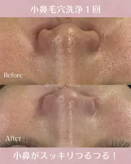 イチゴ鼻🍓毛穴詰まり解消！超音波毛穴洗浄でツルツル小鼻へ✨️再来・性別問わず🌈施術は30分