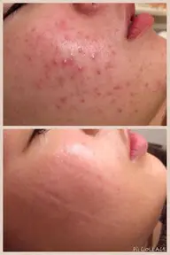 限定🌟【剥離なしピーリング＆鎮静・毛穴収縮Wパックコース】ニキビ/アトピー/毛穴レス/水光肌/ノーファンデ