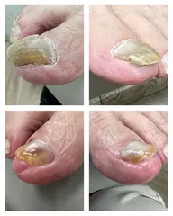 変形爪補正🦶モニター価格❣️