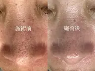 【お試し】いちご鼻・黒ずみ集中ケア✨鼻毛穴洗浄