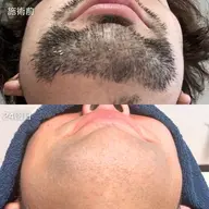 【男性】ヒゲ脱毛 初回キャンペーン価格