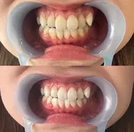 【ミニモ学割U24】学生さん必見★ライトホワイトニング初回★￥1600