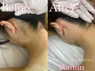 【垢抜け人気★No1】うなじ+もみあげ+デコルテ+脇+背中上 5点セットシュガーリング脱毛