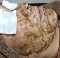 初回お試し ハーブピーリング🌿   お肌ツルツル剥きタマゴ肌✨剥離ありタイプ