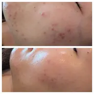 【年齢、本気改善】未来まで見据えたREVIハーブピーリング