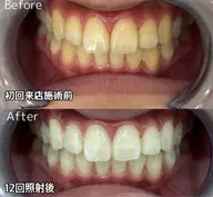 大事な日の前に！セルフホワイトニング×12回照射