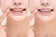 ☆4月限定☆1回で分かるホワイトニングモニター♪2回分💘