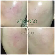 【赤み・ニキビを鎮める 】鎮静肌管理フェイシャル🌿