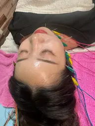 初めてのお試しプチ美容鍼50分✨️メンズも大歓迎《小顔/食いしばり/エラの張り/顎のたるみ/左右差/リフトアップ》