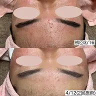 【ニキビ/肌荒れ】プラズマシャワー➕毛穴洗浄（鼻）