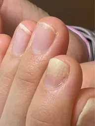 急募☆爪甲剥離症☆自爪育成モデル募集♪初回育成オイル込み価格/２回目以降¥5,660