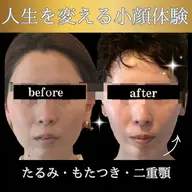 たるみ改善・小顔専門サロン✨小顔フルコース