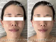 【モニター募集】希少高周波温熱機器 フェイシャル60分 [定価] ¥16,500