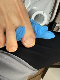 巻き爪根元上げ無料モデル募集❤️‍🔥⚠️注意事項を必ずお読みください⚠️