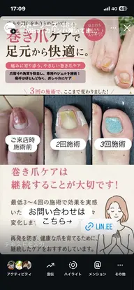 巻き爪ケア(親指1本)