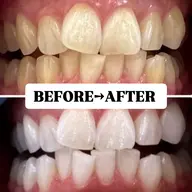 【2回目以降都度払い♪】美白ホワイトニング 20分×2回 ¥7980