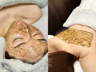 【口コミ割メニュー】《ニキビ・毛穴詰まり改善》ハーブピーリング｜顔or背中