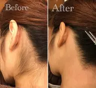 🧸えりあしWAX脱毛🧸