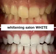 《体験してみたい》という人にオススメ。自分の歯が白くなるのかまずはやってみよう！