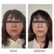 《🌟条件付🌟》人気No.1小顔／小顔リフトアップコース(60分)モニター募集