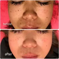 【毛穴レス美肌】美肌フェイシャル 3,400円→2,500円