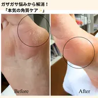 さよなら👋ガチガチかかと、タコ、魚の目