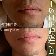 [初回]メンズヒゲ脱毛モニター💆🏻‍♂️※定員埋まり次第掲載終了⚠️メンズもツルスベ肌をスタンダードに❣️