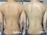 【背中全体｜ざらつき・肌荒れケア】 REVIハーブピーリング🌿陶肌トリートメント