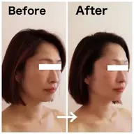 🔶美顔🔶【小顔♪即効リフトアップ！】EMS +超音波で引き締め+顔筋マッサージ100分