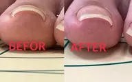 巻き爪ケアコース✳︎韓国初開発の特殊ジェルを使用して巻き爪ケアさせて頂きます✳︎2母趾¥6.600-角質ケア込み✳︎