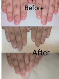 ​【3ヶ月集中】深爪矯正・自爪育成プログラム（全5回）✨長さ出し10本・オフ込み✨39,800