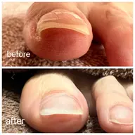 巻き爪、陥入爪補正　#剥離など　✨フットネイルのお悩みを一緒に解消していきましょう。ご相談だけでもぜひご連絡下さいませ。