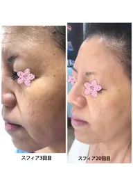 3Dスフィア ヒアルロン酸エステ