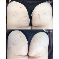 【お尻ハーブピーリング】ニキビケア・毛穴に★(剥離ありor剥離なし選択可）※Google口コミ必須