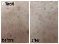 【特別価格】🧡小鼻集中エステ🧡超音波エステ付き　黒ずみ毛穴、ひらき毛穴、毛穴トラブルのないつるすべなお肌に