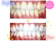 【3月限定特別クーポン🌸 継続率90%以上🦷✨】ホワイトニング【9分×2回】 ¥7980→¥980 別途料金なし