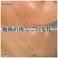 【繰り返すニキビ予防にはコレ!】REVI次世代ハーブ+高濃度ビタミンC/凸凹改善/300種類の天然ハーブ🌿