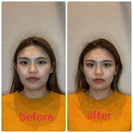 【午前限定】📸before/after写真募集中✨お悩み集中ケア美容鍼10本※補足説明をご確認ください