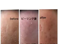 毛穴集中エステ