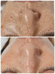 光フェイシャル『シミ▪️シワ▪️くすみ ケア』✩.*˚