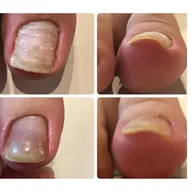 1本につき巻き爪、肥厚爪、陥入爪、変形爪補正