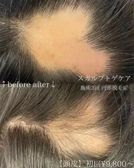 【薄毛】【円形脱毛】【分け目】スカルプトゲケア!毛根に栄養をたっぷり与えて、毛根生き生きと蘇らせる!再生ケア