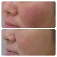 【乾燥・敏感肌でお悩みの方】肌診断+適切な洗顔+鎮静・保湿コース　90分