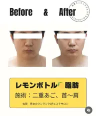 【今注目の小顔】レ モンボト ル★顔の脂肪が多い方用