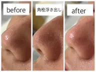 口コミ投稿必須✍️超お得★詰り,汚れをなくす!毛穴洗浄&吸引!¥5980→3980