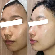 【初回半額】結果重視！スッピン力を底上げする本格天然ハーブピーリング『ハーバルシー』アフターケア施術1回付き